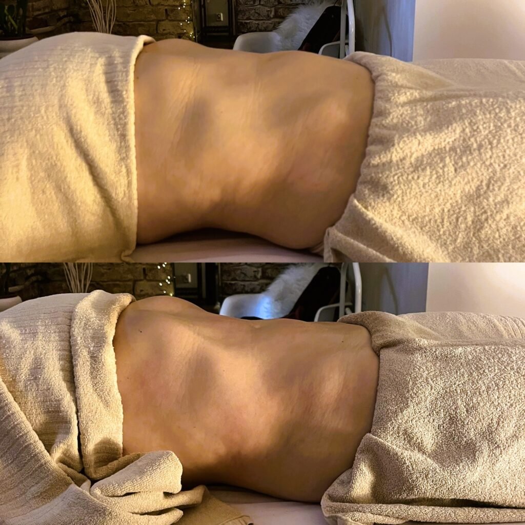 Lymfomodeling, lymfomodelace, lymph-modeling