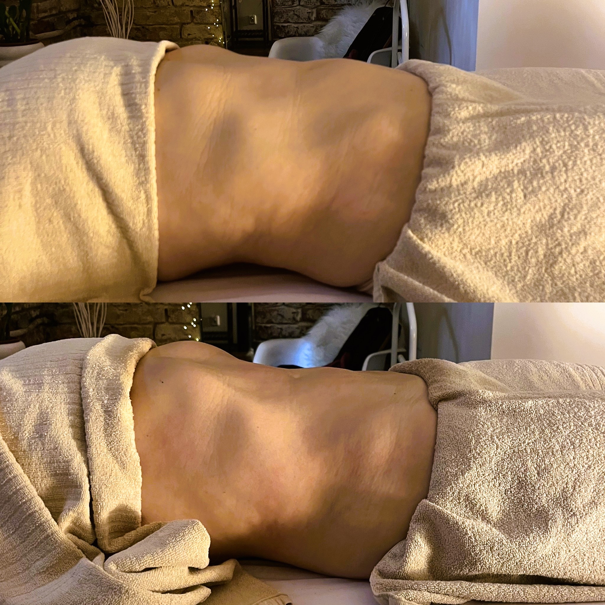 Lymfomodeling, lymfomodelace, lymph-modeling