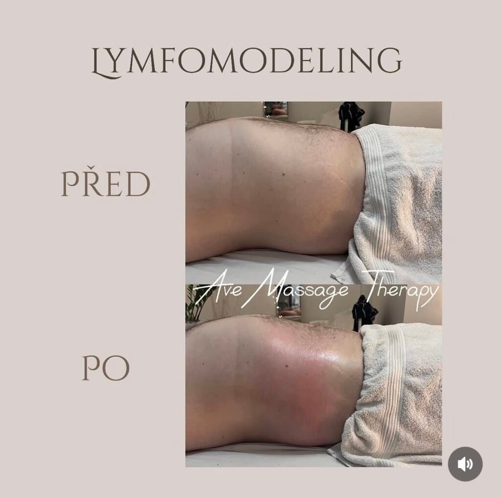 LYMFOMODELING BŘICHA PRAHA