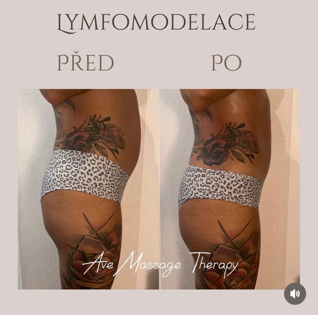 LYMFOMODELING BŘICHA PRAHA