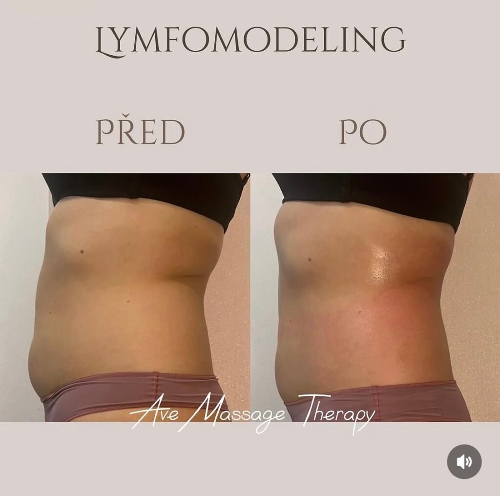 LYMFOMODELING BŘICHA PRAHA