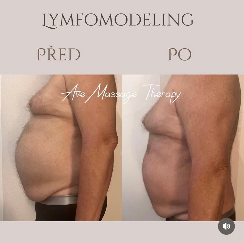 LYMFOMODELING BŘICHA PRAHA